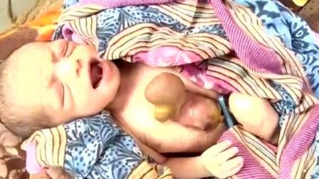 奇闻: 印度一女婴的心脏长在身体外, 还能看到它跳动的样子!