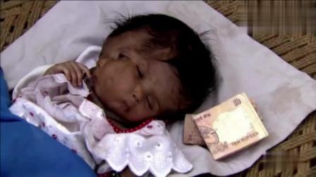 印度夫妇生下双面女婴, 两张嘴巴四只眼, 被村民视为神灵转世