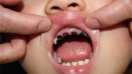 三岁孩子从不吃糖却满嘴烂牙, 原来这些习惯比吃糖更可怕