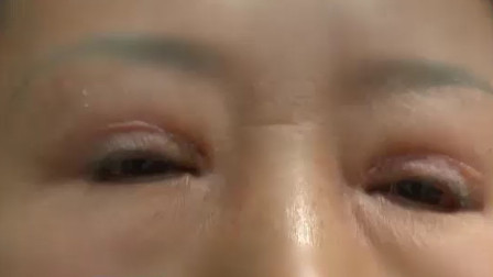 女子开眼角做割双眼皮手术, 结果做完后睡觉都闭不上眼