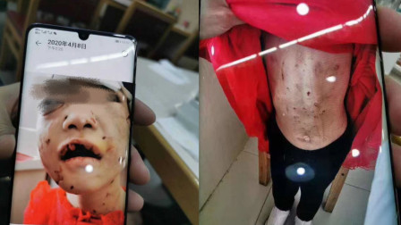 哈尔滨儿童医院：被虐打4岁女童有生命危险 仍昏迷