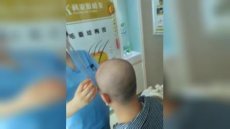 深圳毛发种植效果图植发的危害北京